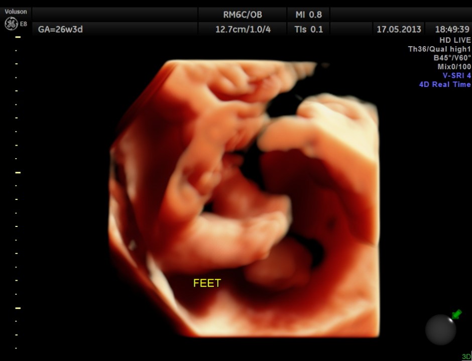 CARBAMAZEPINE CEREBELLAR HYPO_27