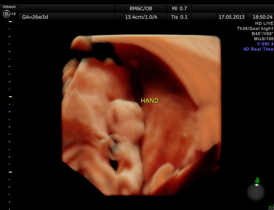 CARBAMAZEPINE CEREBELLAR HYPO_28