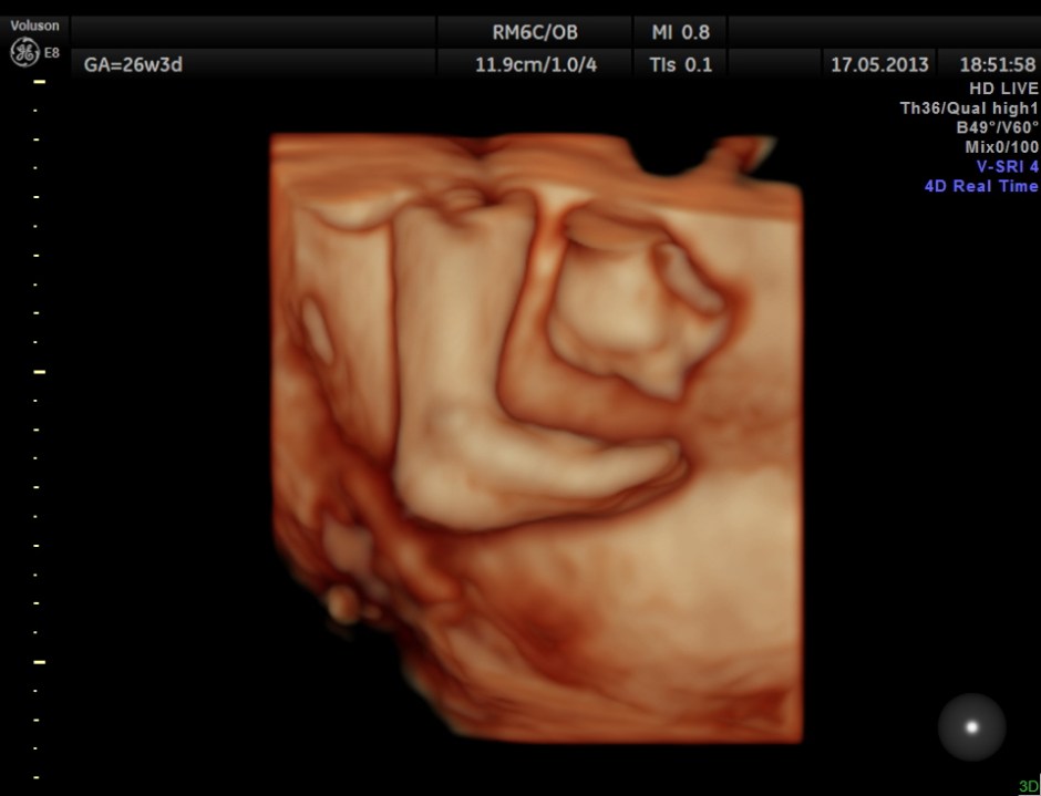 CARBAMAZEPINE CEREBELLAR HYPO_29