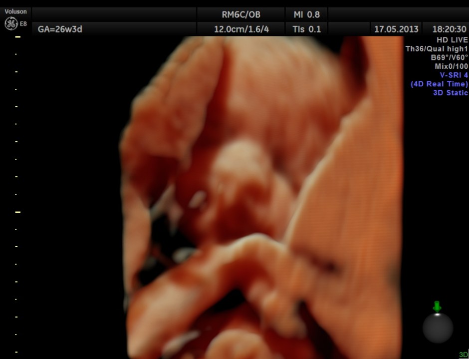 CARBAMAZEPINE CEREBELLAR HYPO_3