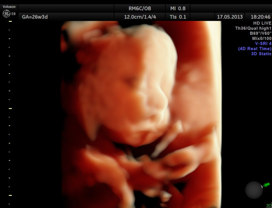 CARBAMAZEPINE CEREBELLAR HYPO_4