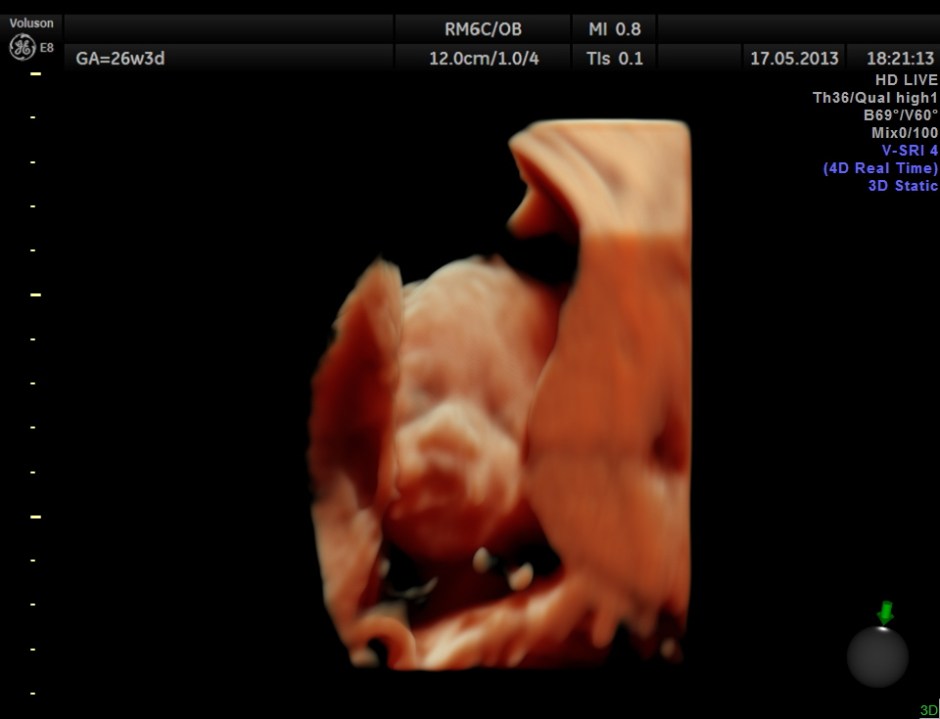 CARBAMAZEPINE CEREBELLAR HYPO_5