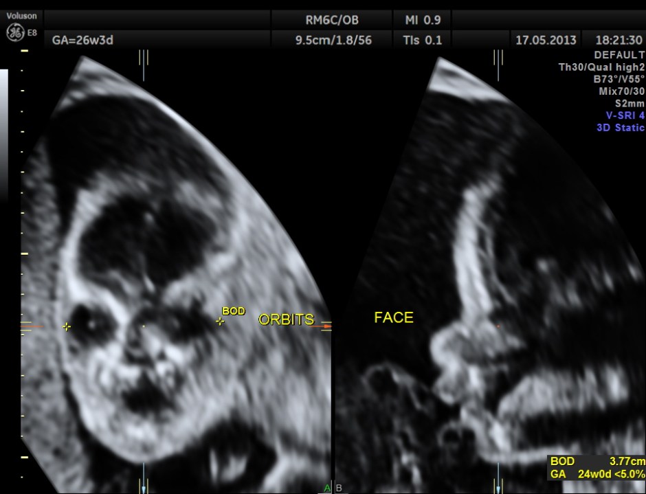 CARBAMAZEPINE CEREBELLAR HYPO_6