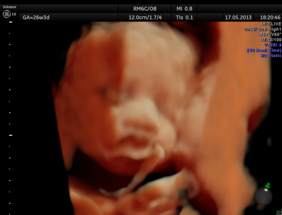 CARBAMAZEPINE CEREBELLAR HYPO_7