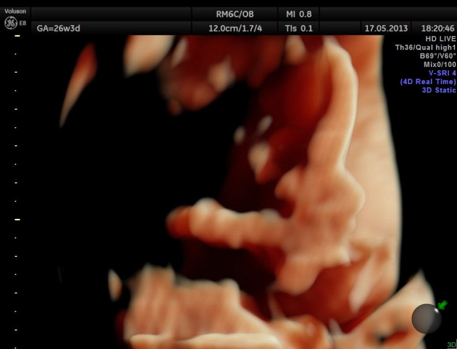CARBAMAZEPINE CEREBELLAR HYPO_8