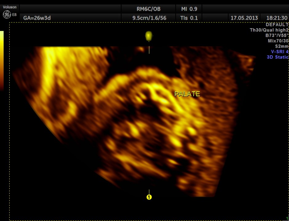 CARBAMAZEPINE CEREBELLAR HYPO_9