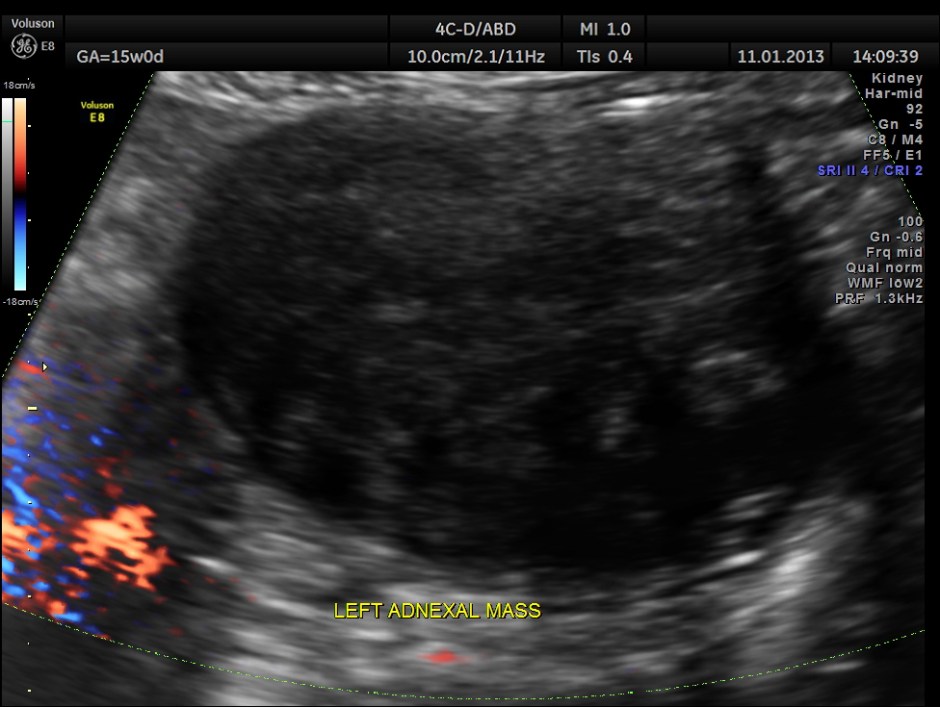 OVARIAN FIBROMA COMPL PREG_19
