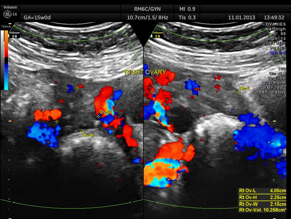 OVARIAN FIBROMA COMPL PREG_2