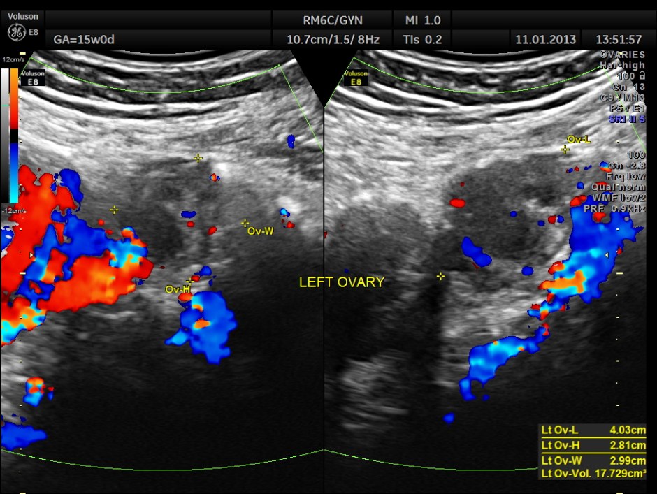 OVARIAN FIBROMA COMPL PREG_3