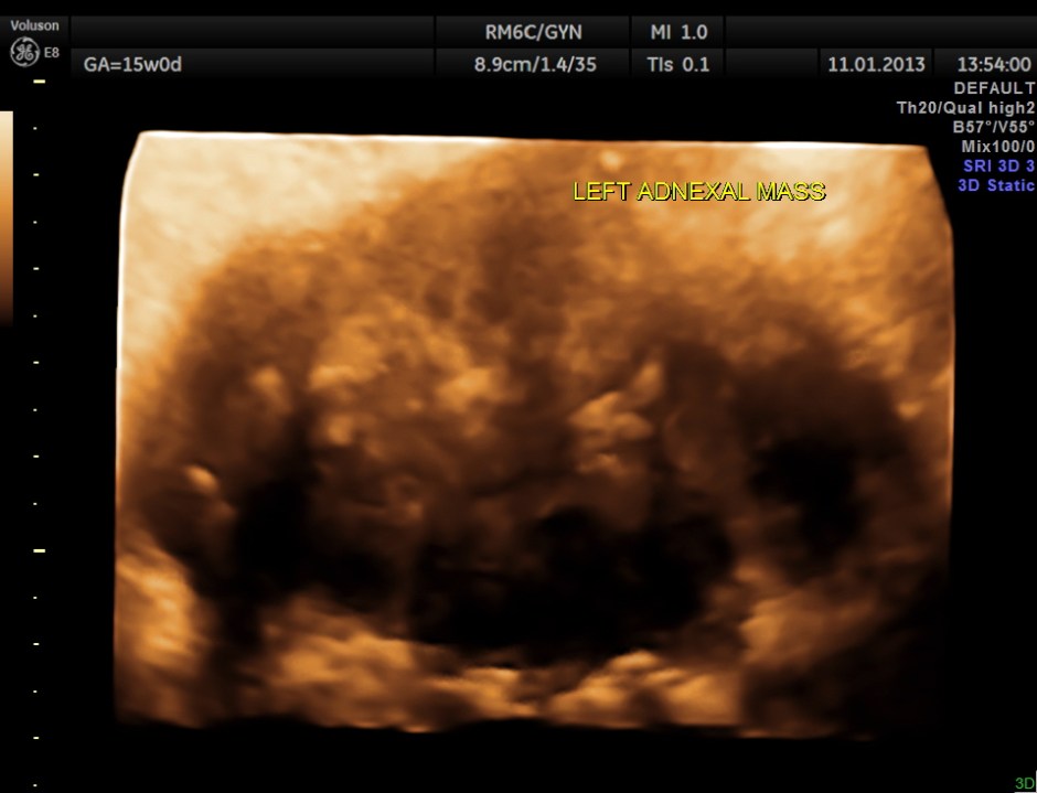 OVARIAN FIBROMA COMPL PREG_4