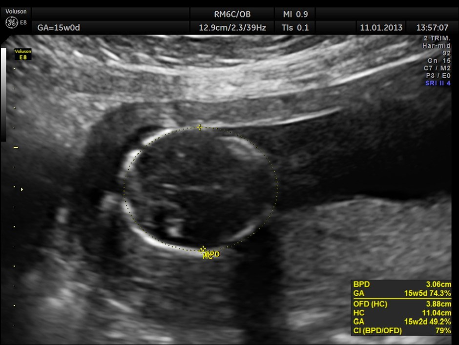 OVARIAN FIBROMA COMPL PREG_6