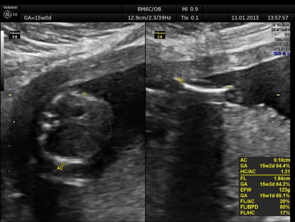 OVARIAN FIBROMA COMPL PREG_8