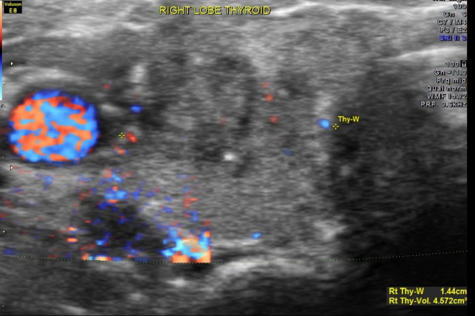THYROID PAP CA FIBROID_10