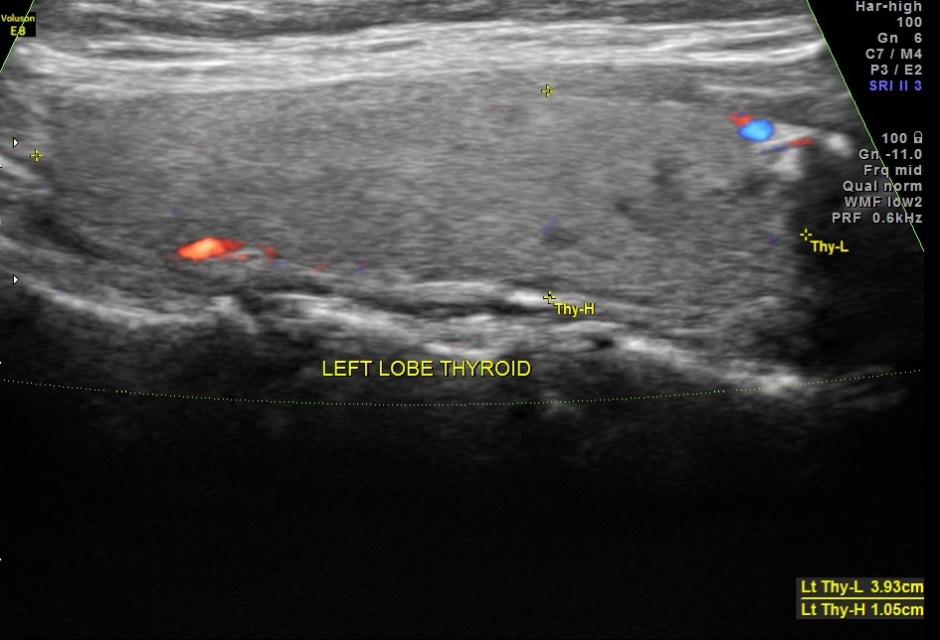 THYROID PAP CA FIBROID_11