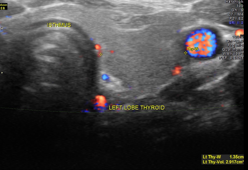 THYROID PAP CA FIBROID_12