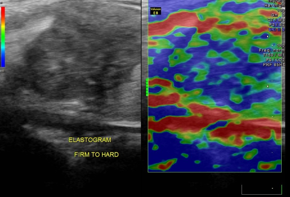 THYROID PAP CA FIBROID_13
