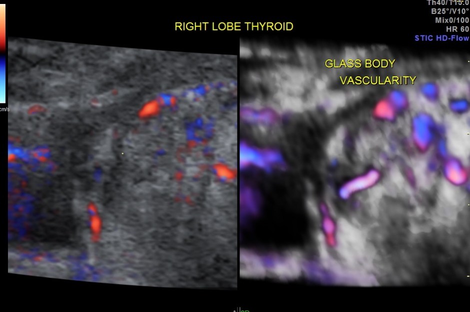 THYROID PAP CA FIBROID_22