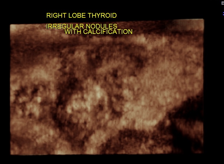 THYROID PAP CA FIBROID_23