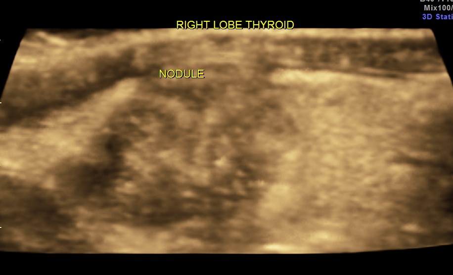 THYROID PAP CA FIBROID_24