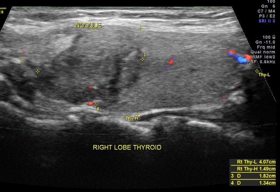 THYROID PAP CA FIBROID_9