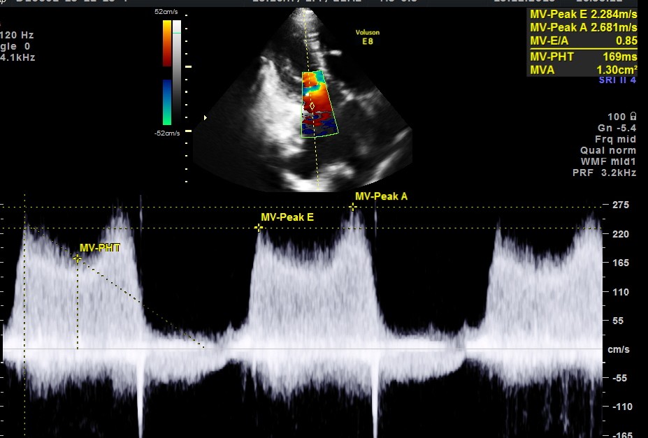 pressure half time calculation reveals moderate mitral stenosis