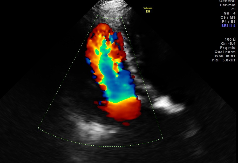 colour doppler shows the classical candle flame sign 