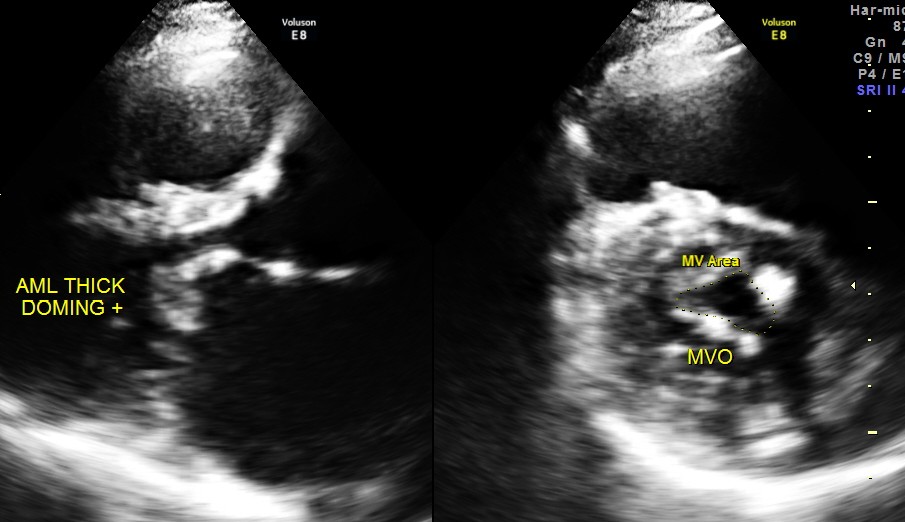 mitral leaflets are thickened  anterior mitral leaflet shows doming 