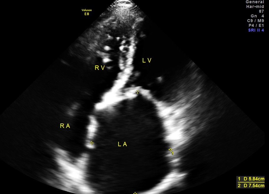 left atrium is enlarged 