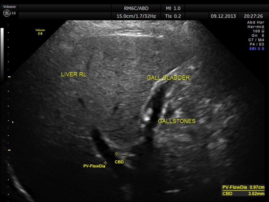 how many gallstones are seen ?