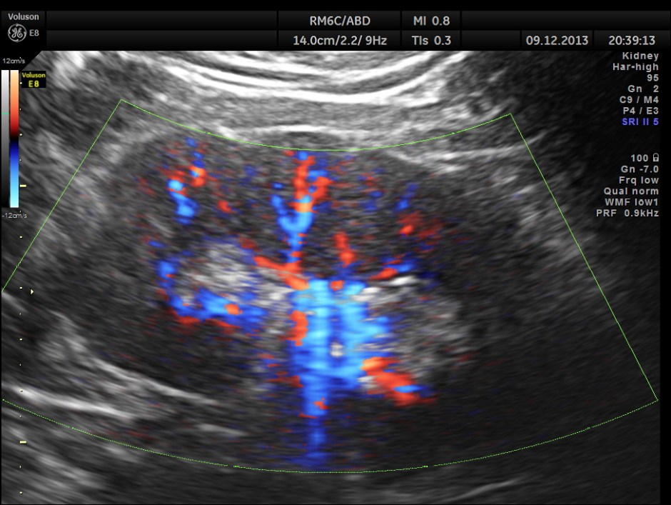 IMG_20131209_1 RENAL MASS_11