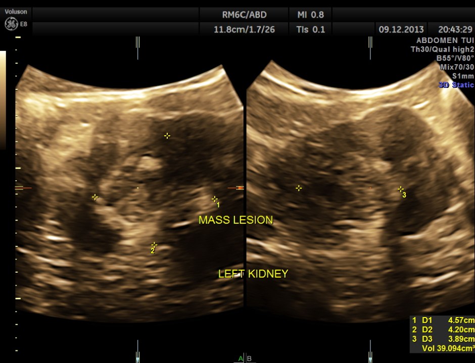 IMG_20131209_1 RENAL MASS_13