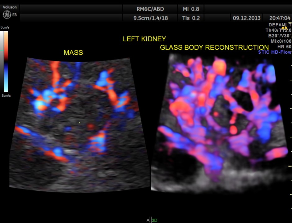 IMG_20131209_1 RENAL MASS_15