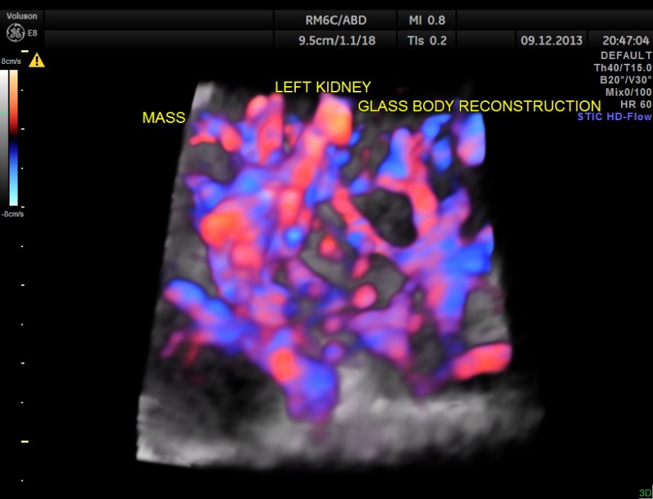 IMG_20131209_1 RENAL MASS_16