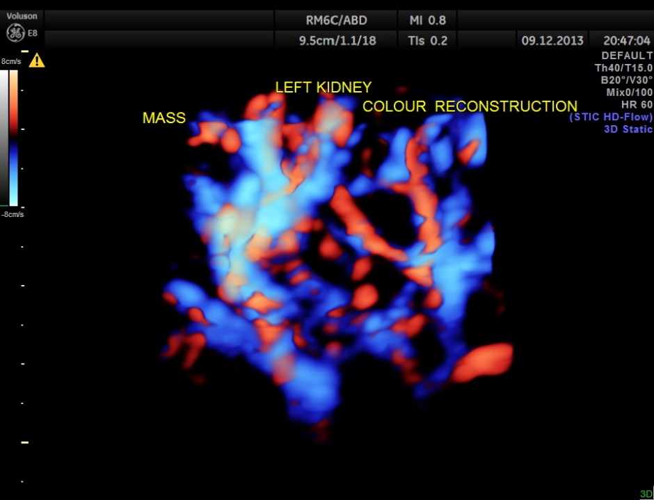 IMG_20131209_1 RENAL MASS_18