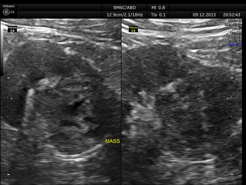 IMG_20131209_1 RENAL MASS_21