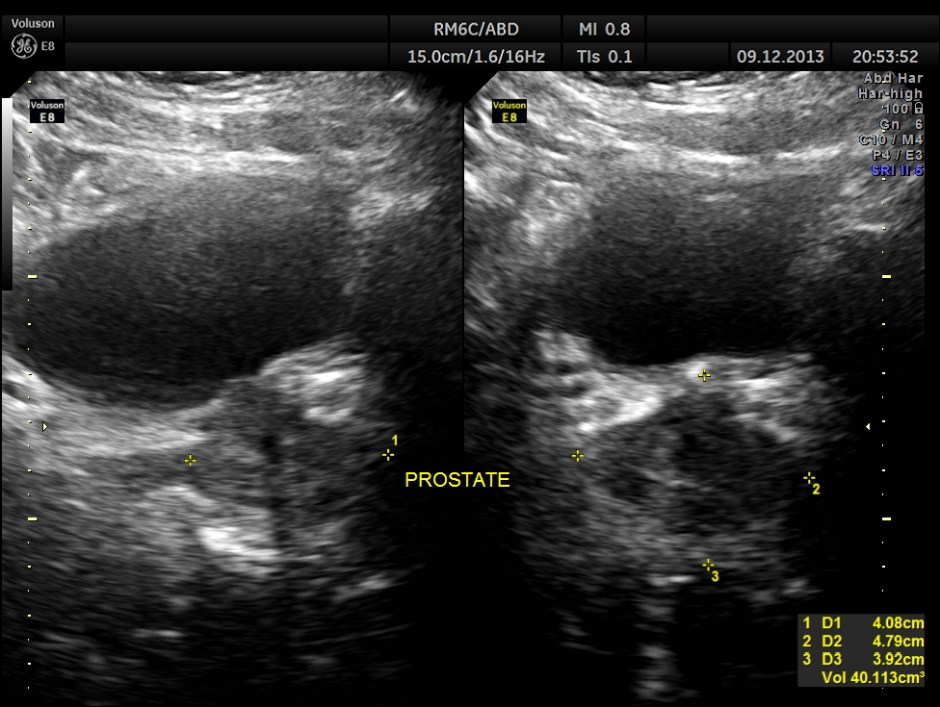 IMG_20131209_1 RENAL MASS_22