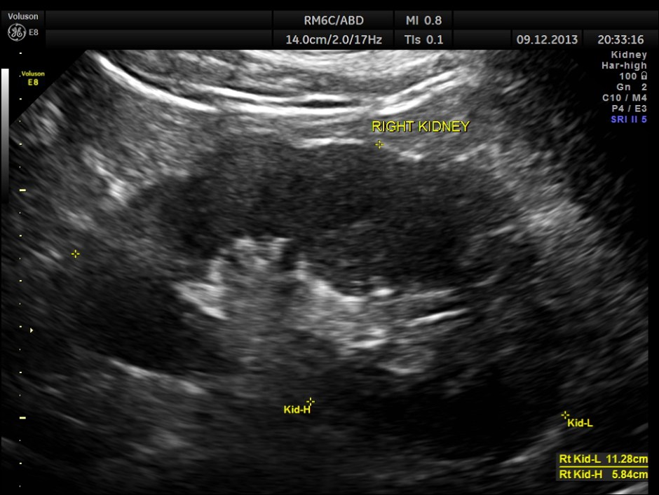 IMG_20131209_1 RENAL MASS_5