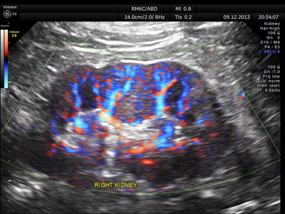IMG_20131209_1 RENAL MASS_6