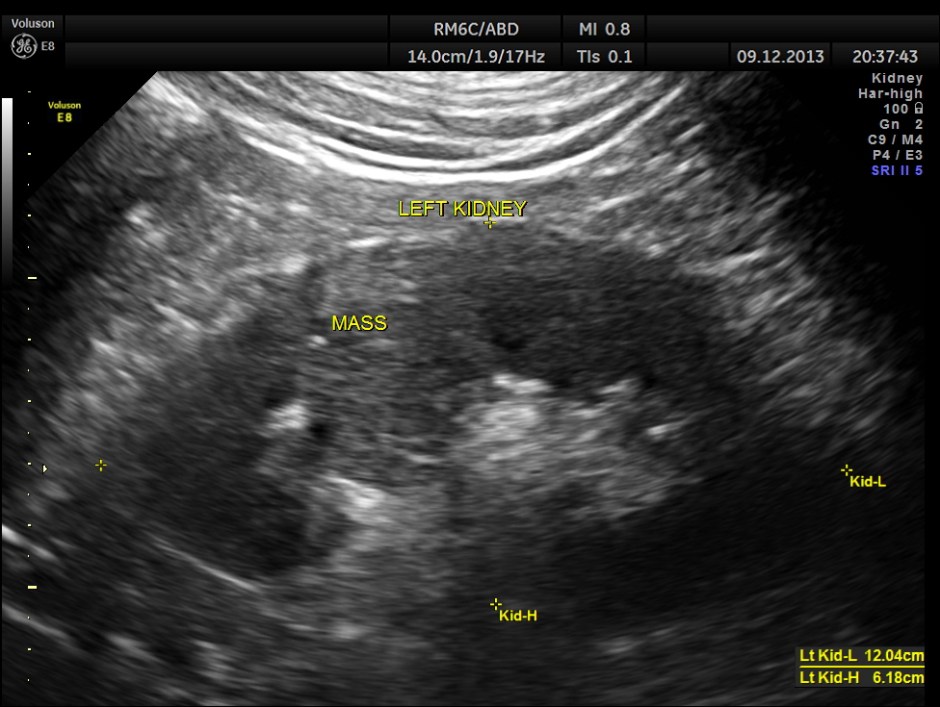 IMG_20131209_1 RENAL MASS_9