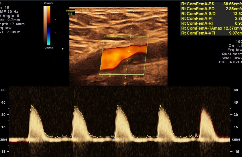 Rt common femoral artery showed monophasic flow
