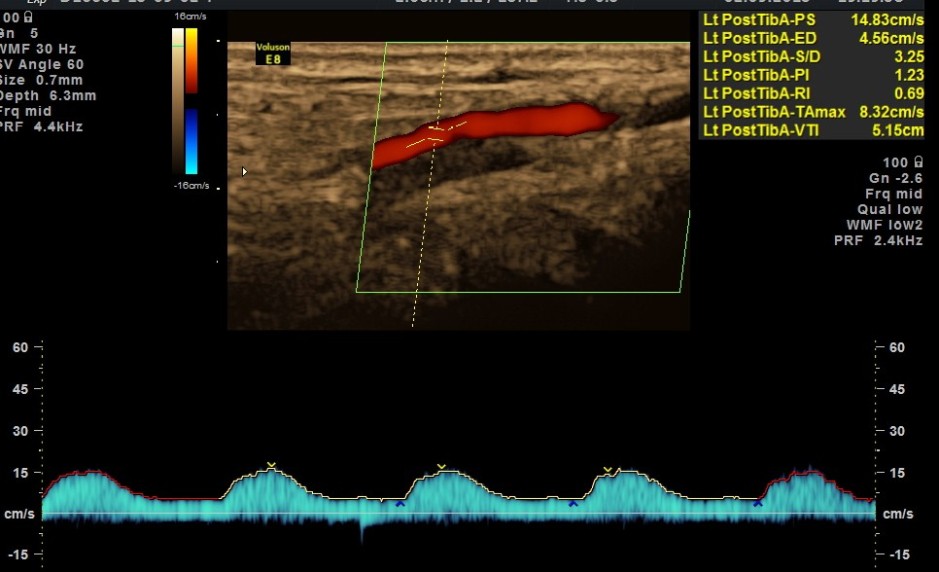LEFT POSTERIOR TIBIAL ARTERY SHOWS MONOPHASIC FLOW
