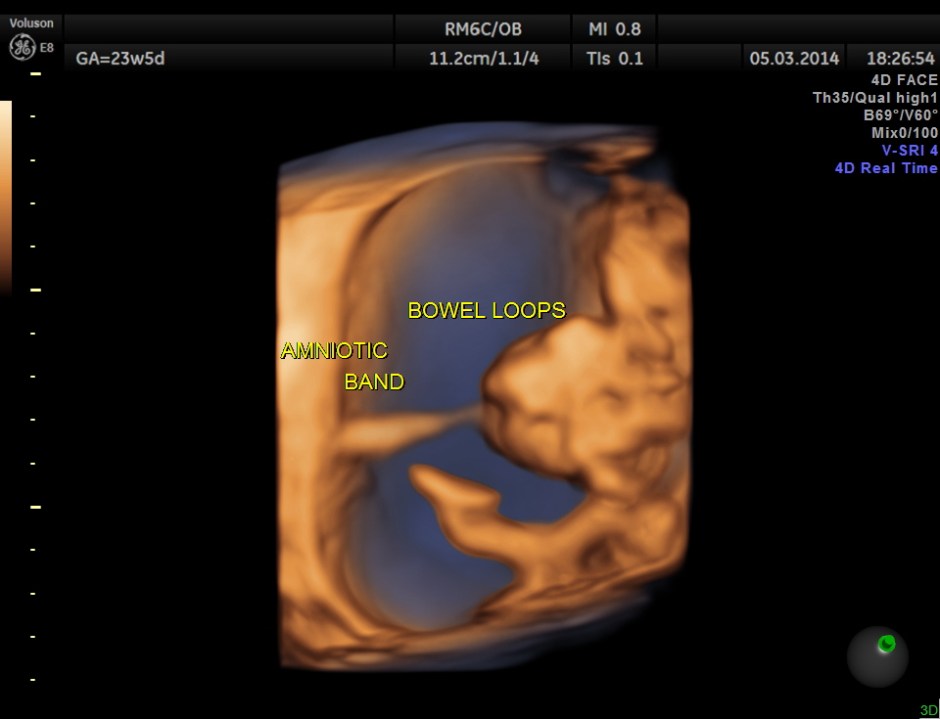 urinary bladder | Looking Through a Transducer