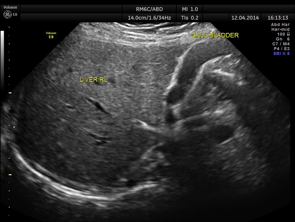 KID  DISTAL UR CALCULUS_1