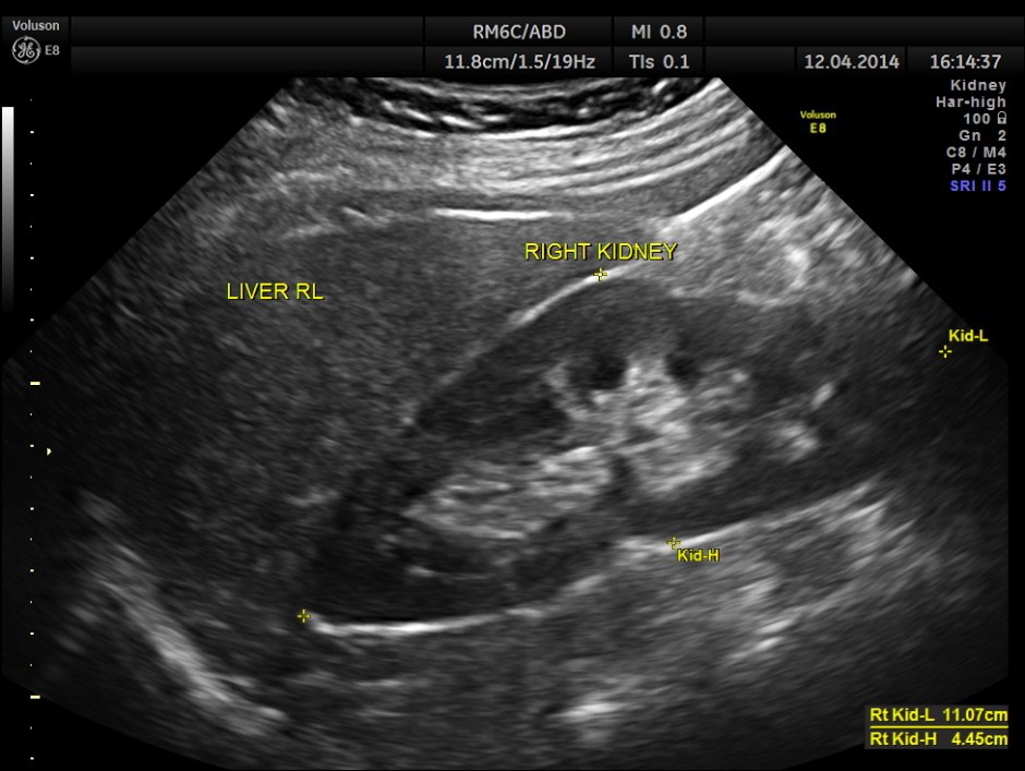 KID  DISTAL UR CALCULUS_3