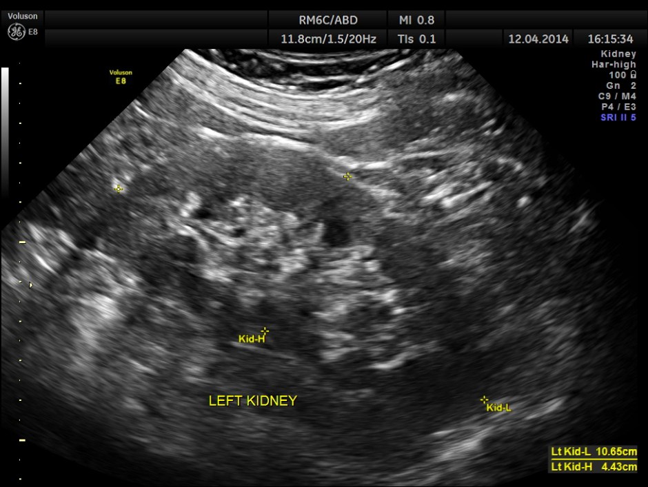 KID  DISTAL UR CALCULUS_4