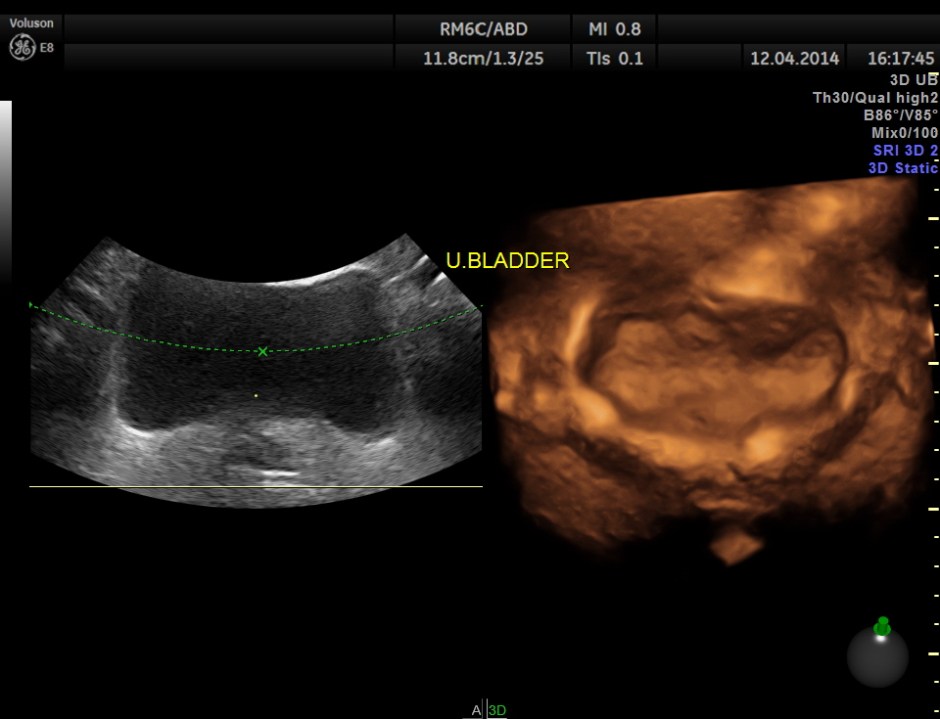 KID  DISTAL UR CALCULUS_6