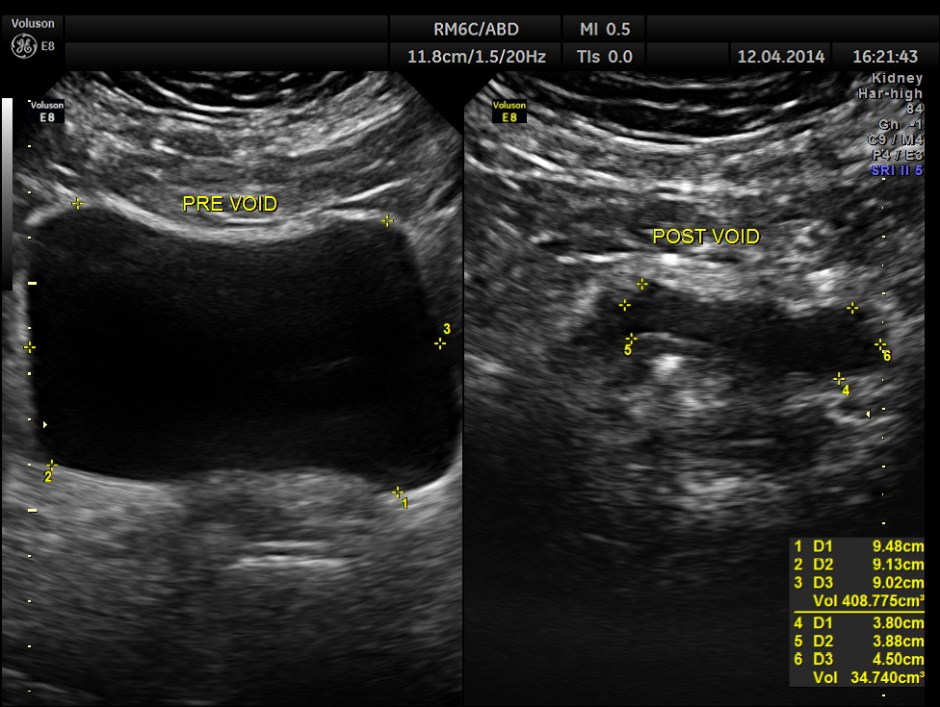 KID  DISTAL UR CALCULUS_7