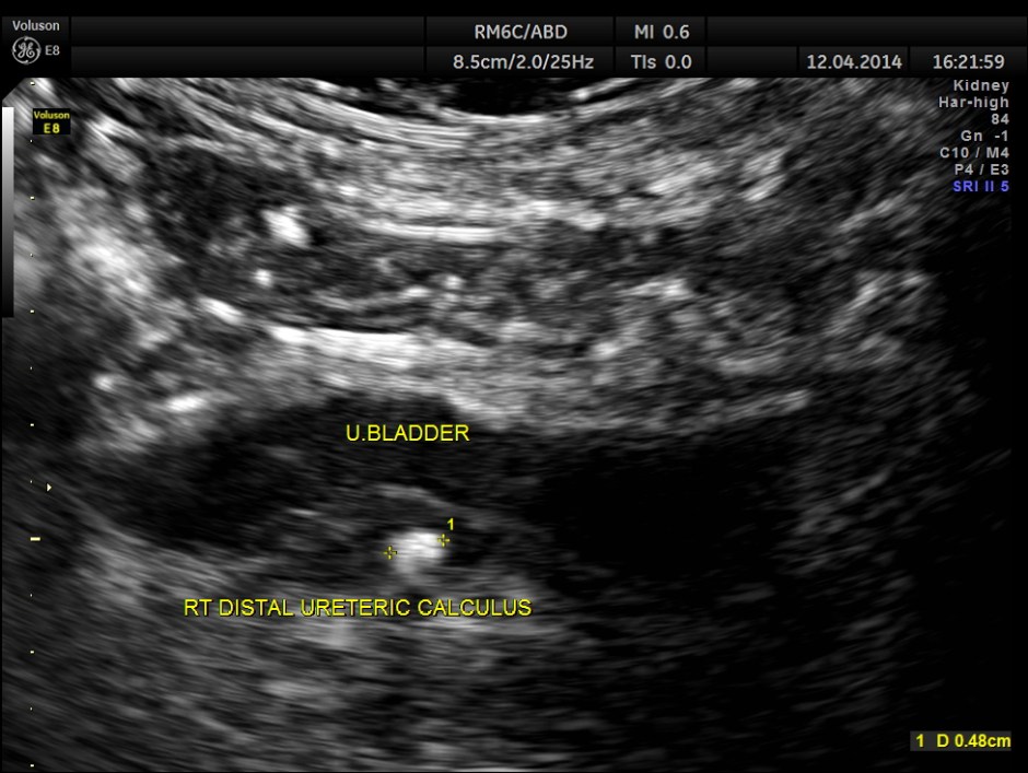 KID  DISTAL UR CALCULUS_8