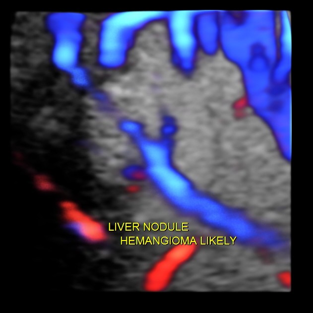 IMG_20131128_1 HEMANGIOMA_2