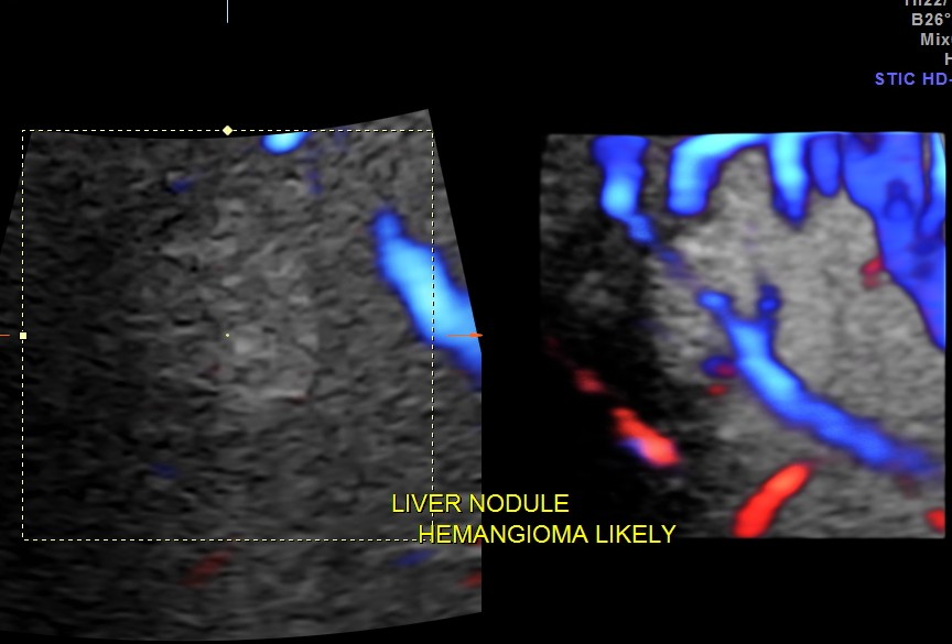 IMG_20131128_1 HEMANGIOMA_3